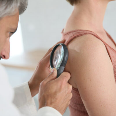 Melanoma: Prevention, Symptoms, and Treatment