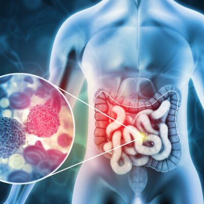 6 Early Symptoms of Colon Cancer