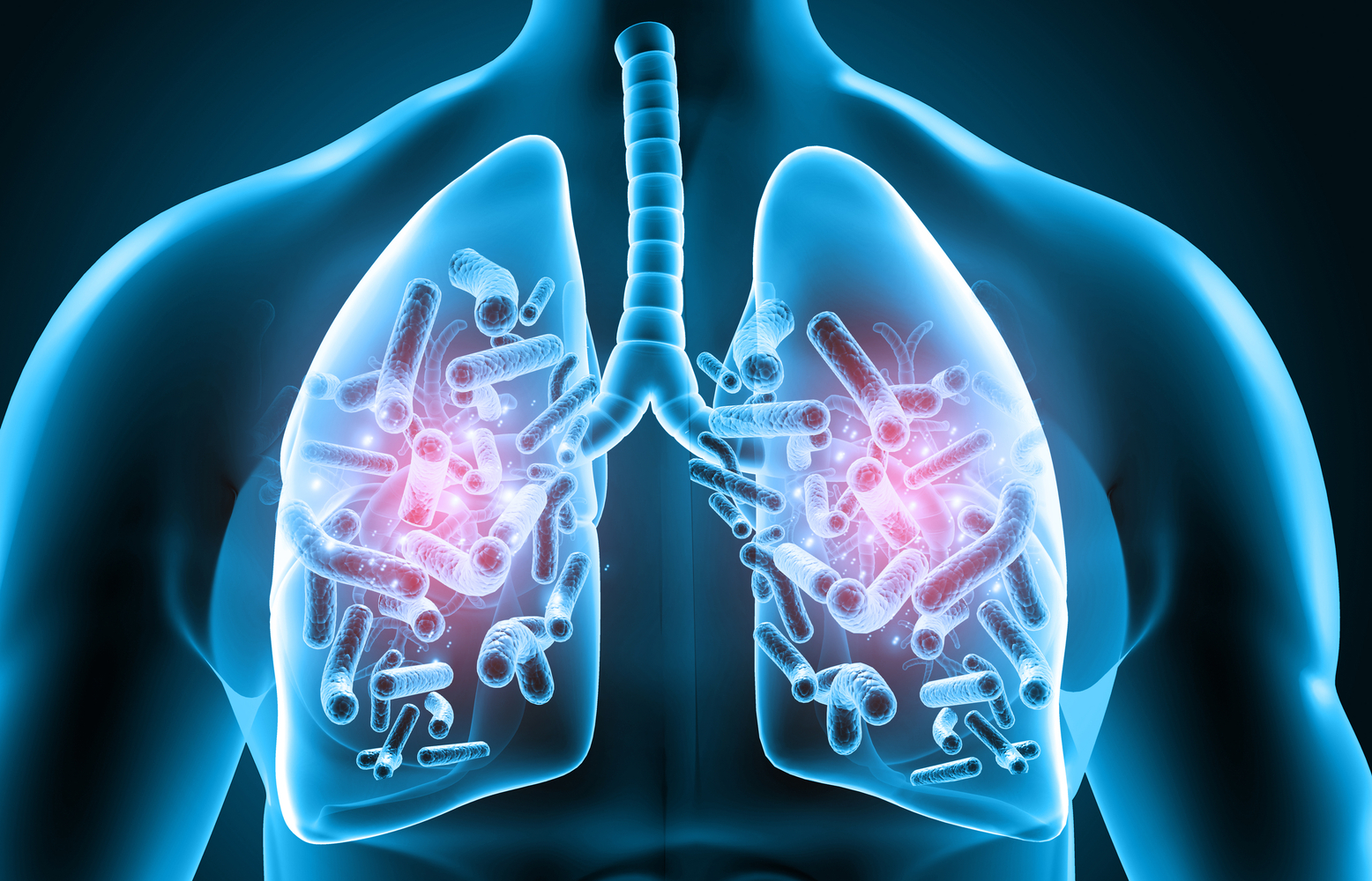 What Is Mac Lung Disease and How is it Contracted?