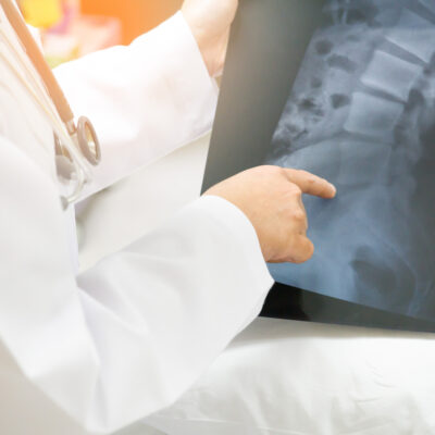 Early Symptoms and Main Cause of Ankylosing Spondylitis